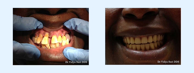 Denture Repair Frisco Little Elm - Frisco Elm Dental Before and After Patient