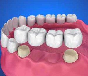 Quality dental crowns rebuild damaged teeth in Little Elm TX