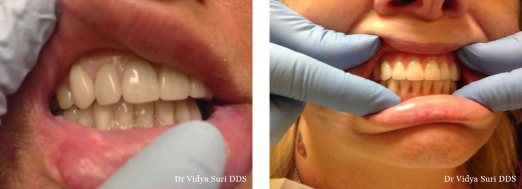 Smile Gallery Little Elm - Dentures Before & After Treatment Case 05
