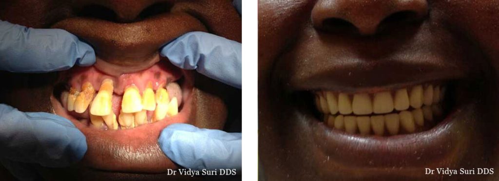 Smile Gallery Little Elm - Dentures Before & After Treatment Case 06